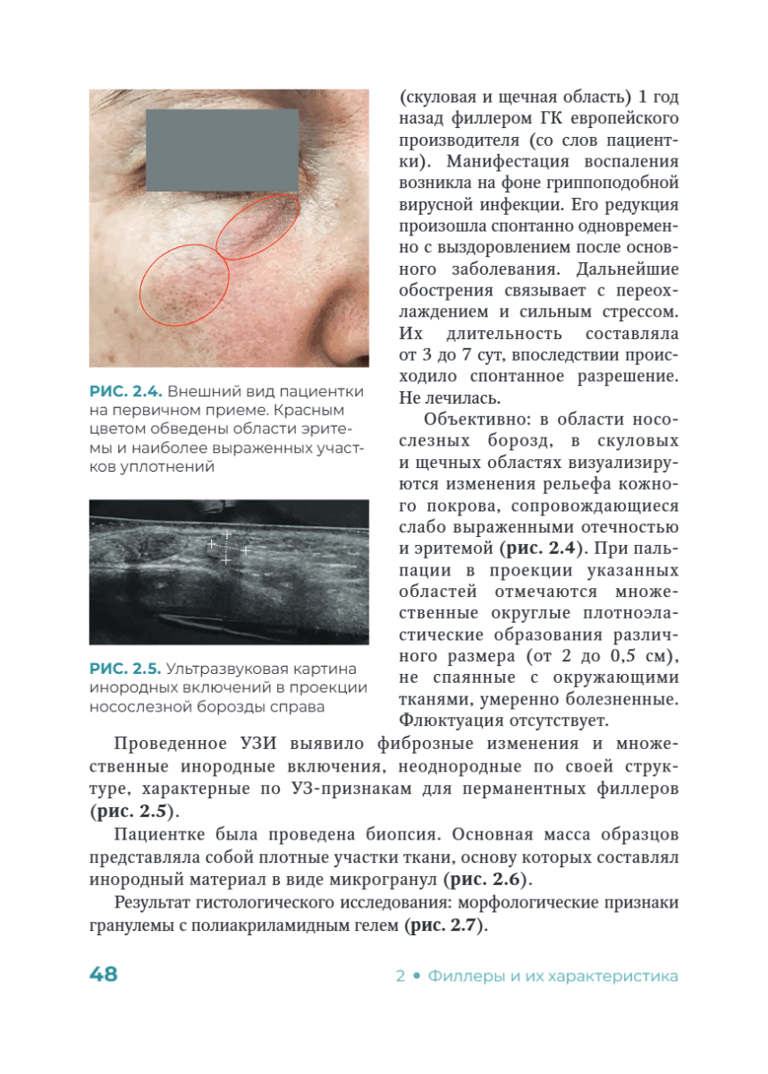Постинъекционные осложнения в косметологии — изображение 8